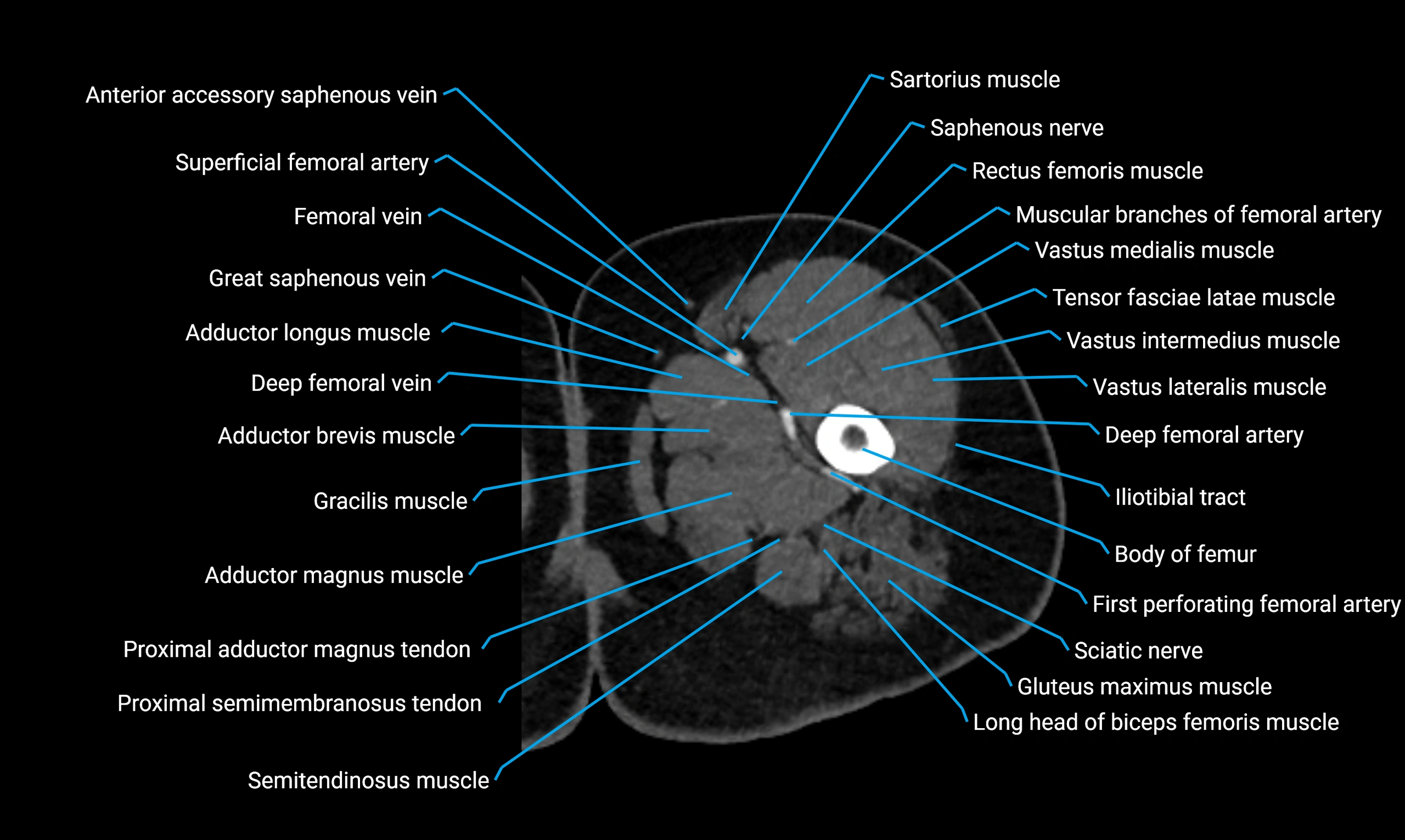 CT thigh axial cross sectional anatomy labelled image_28 (3).webp